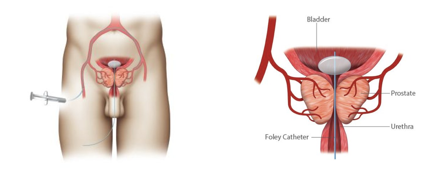 Diagram of a catheter passed from the top of the thigh into the arteries supplying the prostate