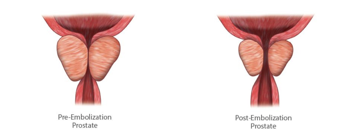 Diagram comparing an enlarged prostate compressing the urethra before embolization with a smaller prostate and open urethra after embolization
