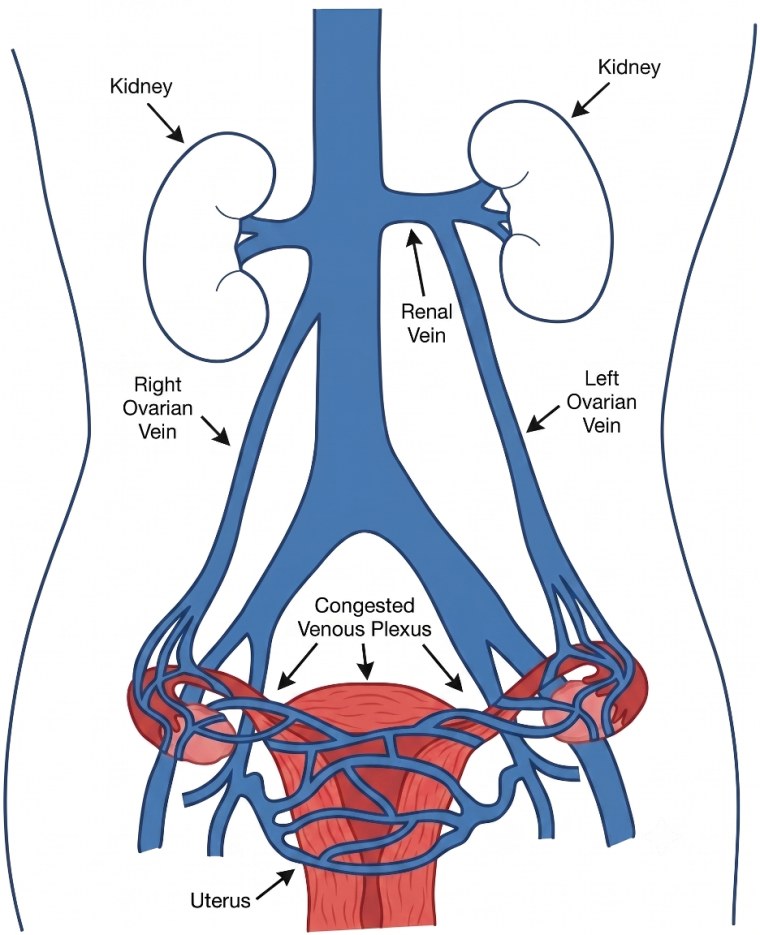Diagram of the ovarian veins and the congested venous plexus around the uterus