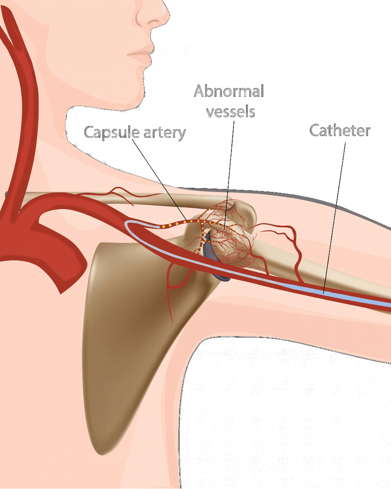 Diagram of the shoulder showing the capsule artery, the abnormal new vessels growing in the inflamed joint capsule, and the catheter passed up the arm to reach them