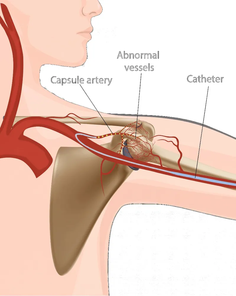 Diagram of the shoulder showing the capsule artery, the abnormal new vessels growing in the inflamed joint capsule, and the catheter passed up the arm to reach them