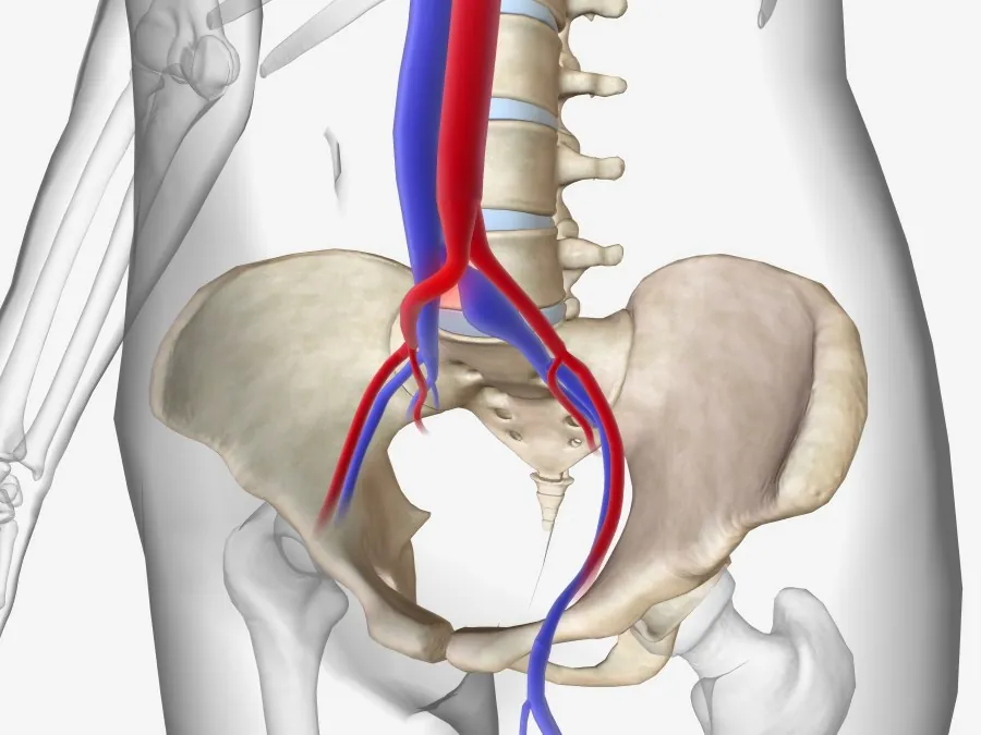 Anatomical illustration showing the right iliac artery crossing over and compressing the left iliac vein against the spine