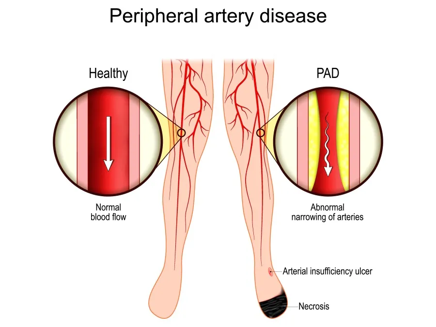 Diagram comparing healthy arterial blood flow with peripheral artery disease