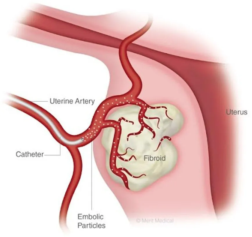 Diagram showing embolic particles being released into the uterine artery to block blood flow to a fibroid