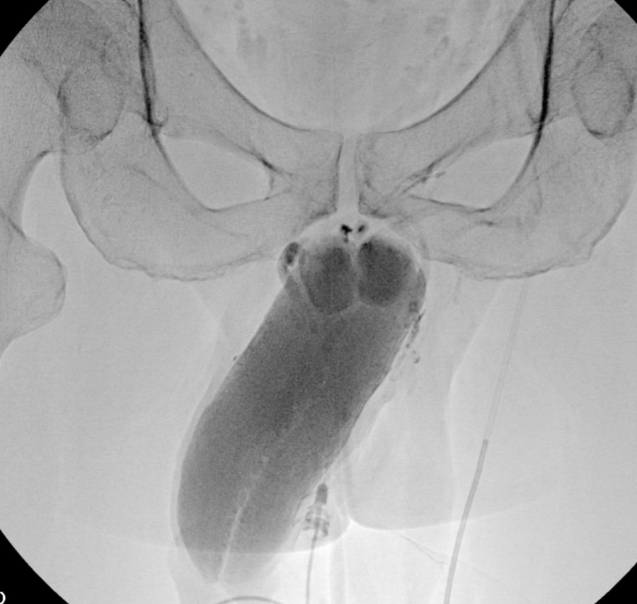 Fluoroscopy image showing abnormal venous drainage from the penis