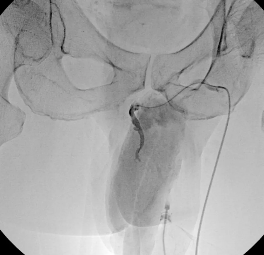 Fluoroscopy image showing the penile veins after embolization